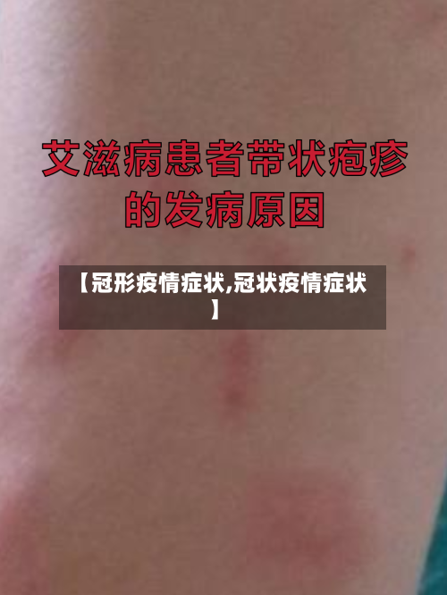 【冠形疫情症状,冠状疫情症状】